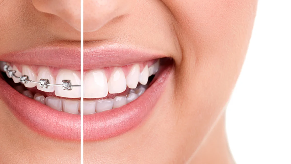 salem braces