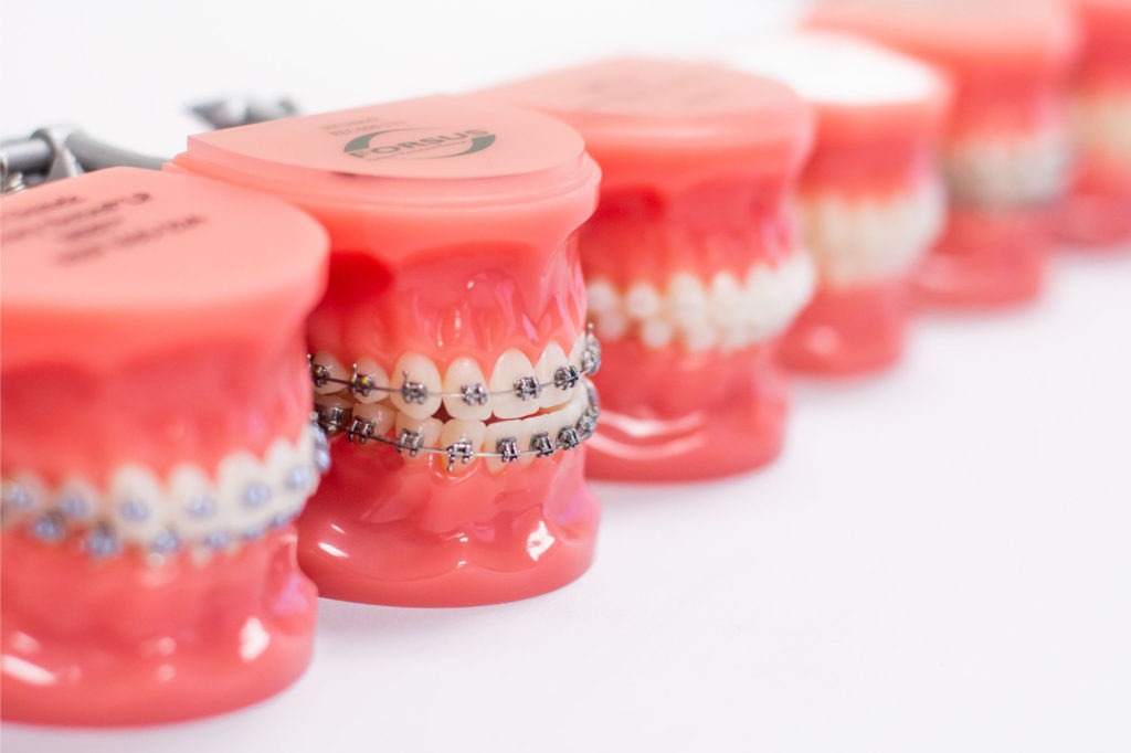 Side-by-side dental models showing teeth with braces at an orthodontist in Payson