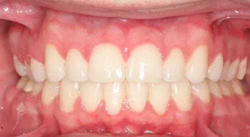 after Image