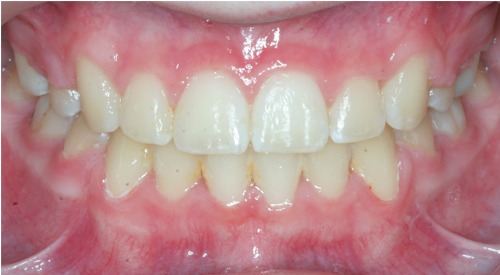 after Image