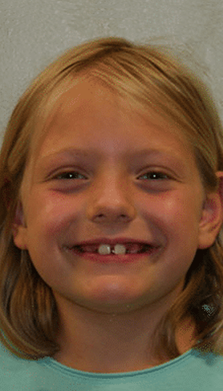 salem braces
