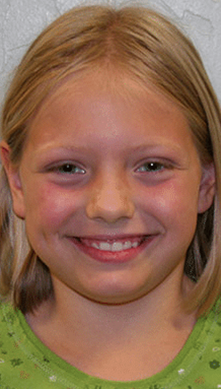 Happy young girl after successful orthodontic treatment.