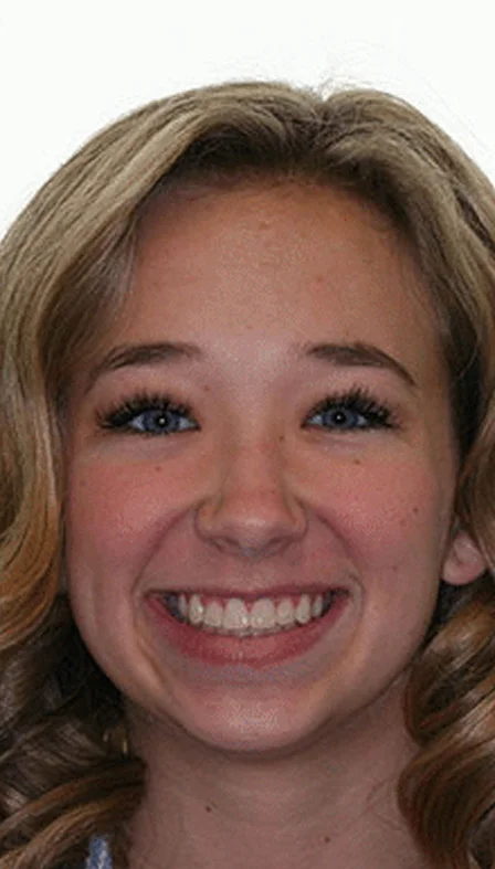 Smiling girl with straight teeth after braces treatment.