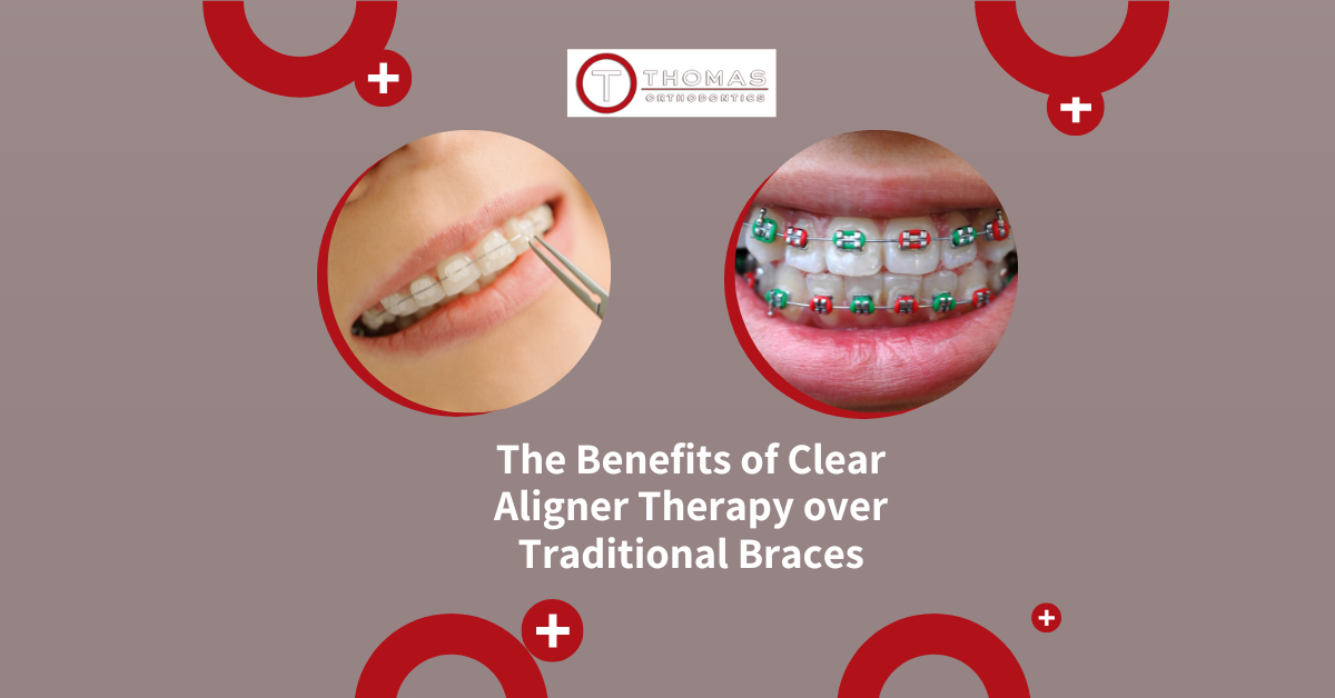 The Benefits of Clear Aligner Therapy over Traditional Braces