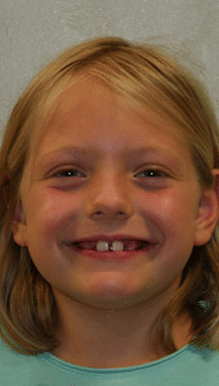 Young girl with missing teeth before orthodontic treatment.