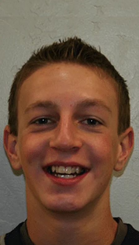 Teen boy smiling confidently after orthodontic braces treatment.