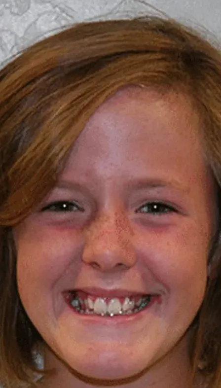 Young girl with misaligned teeth before braces treatment.