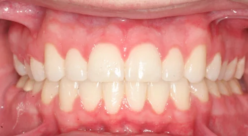 Healthy gums and straight teeth after orthodontic treatment.