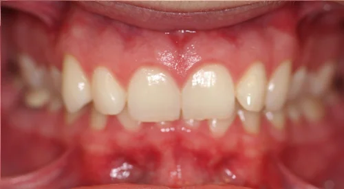 Close-up of inflamed gums and misaligned teeth before treatment.