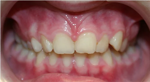 Before the procedure, a close-up photo of misaligned teeth.