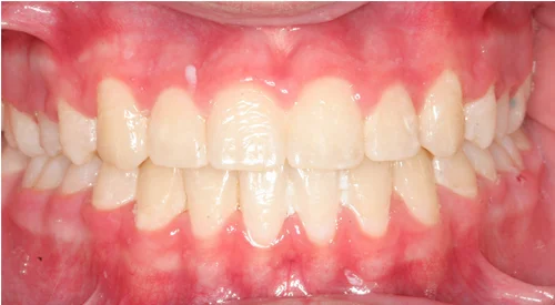 After the procedure, a close-up photo showcasing aligned teeth.